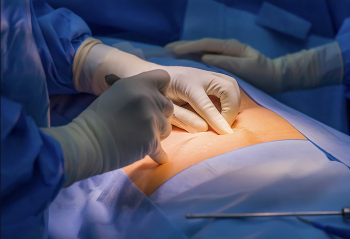 Top Hernia Surgeon in Dubai and Expert General Surgeon in Dubai for Your Health